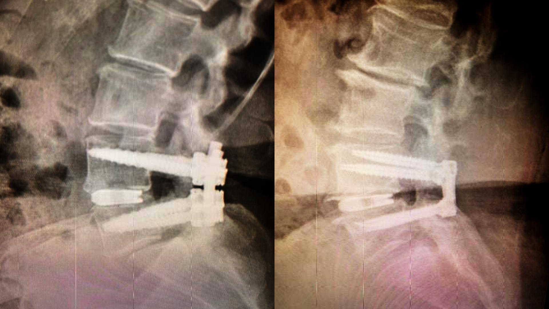 PressON™ is Smaller.Faster.Stronger - Nexus Spine